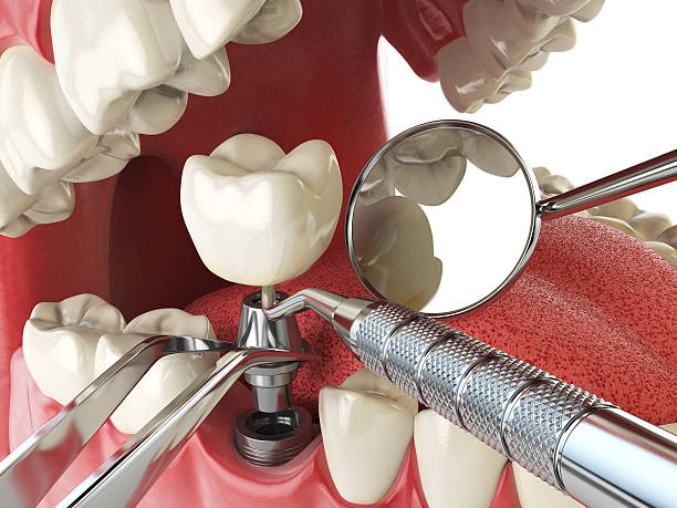 Best Emergency Tooth Extraction in Smithville Sanders, IN